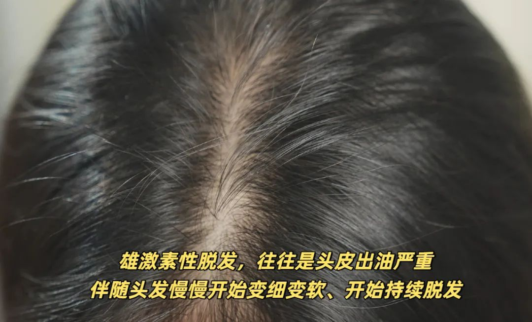 头油掉发？三步清爽救你！